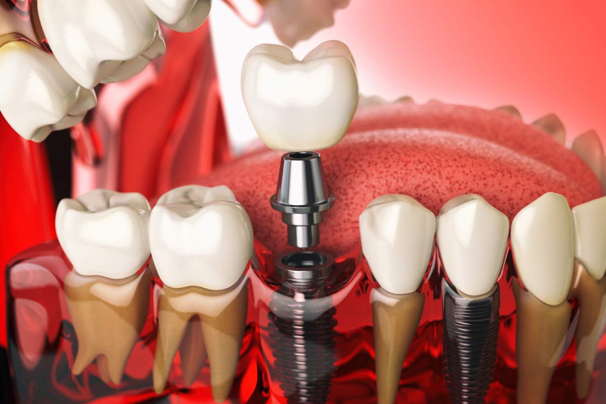 diagram showing how a dental implant is placed